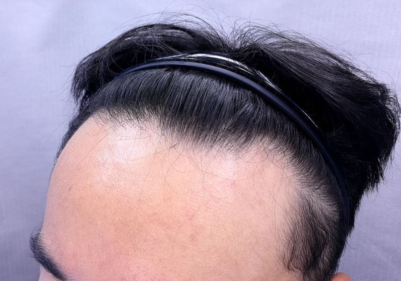 임지호 헤어라인 수술전.JPG