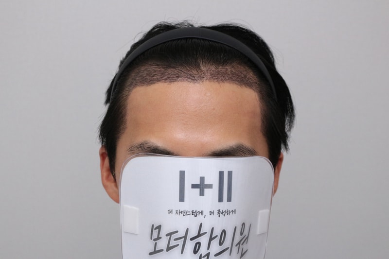 비절개 투블럭 모발이식 13일 경과, 모더함 정한별원장님 