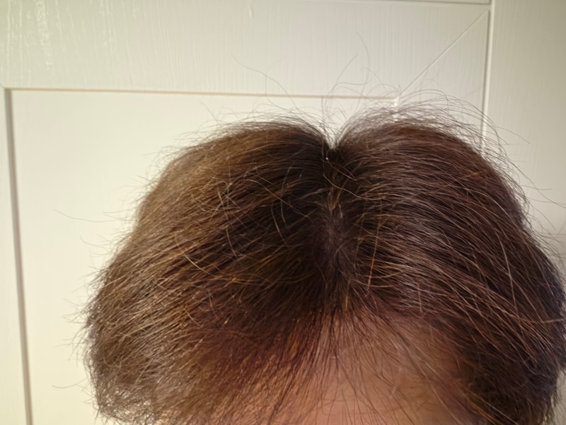 정수리 모발 이식 1년 경과 후기