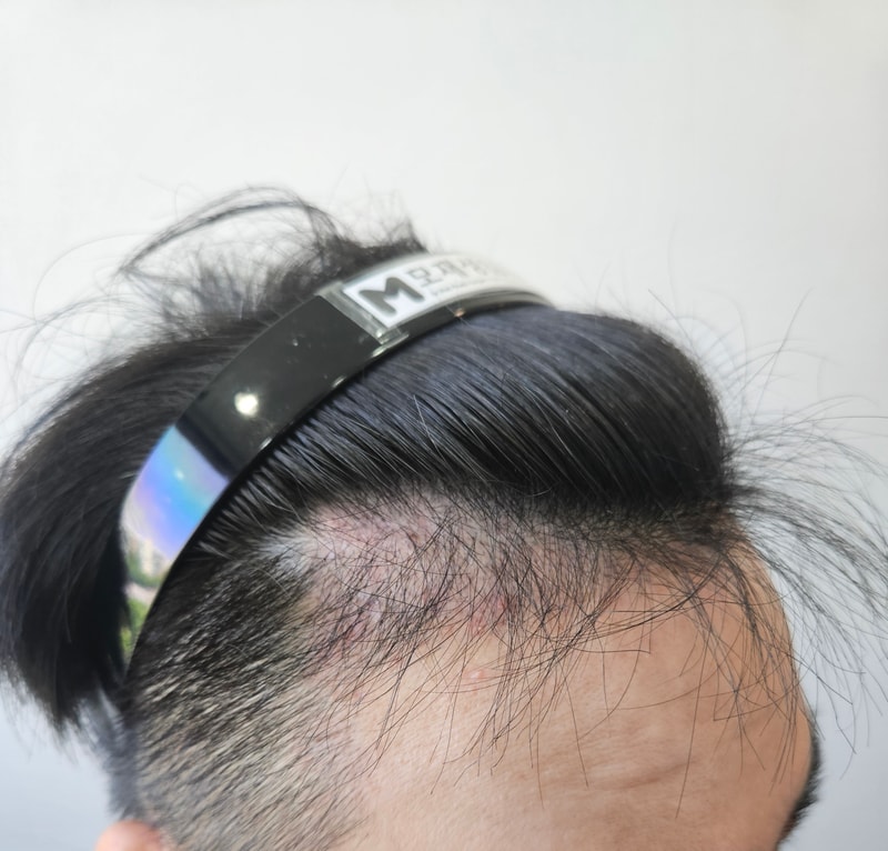 남성M자 4개월차 후기