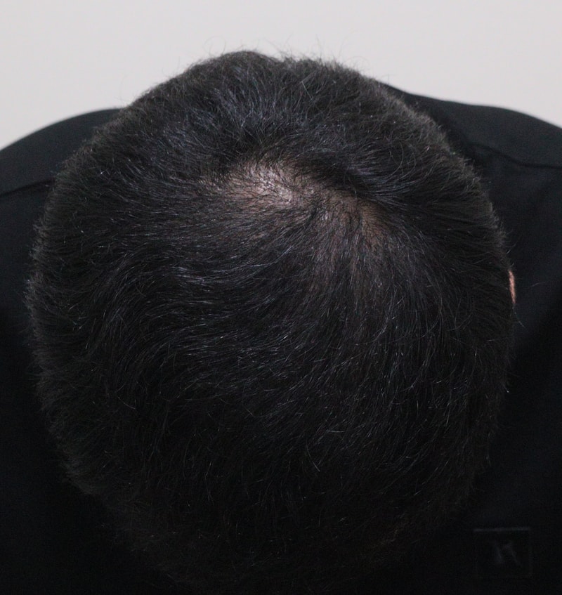 5. 수술후_1년_1.JPG