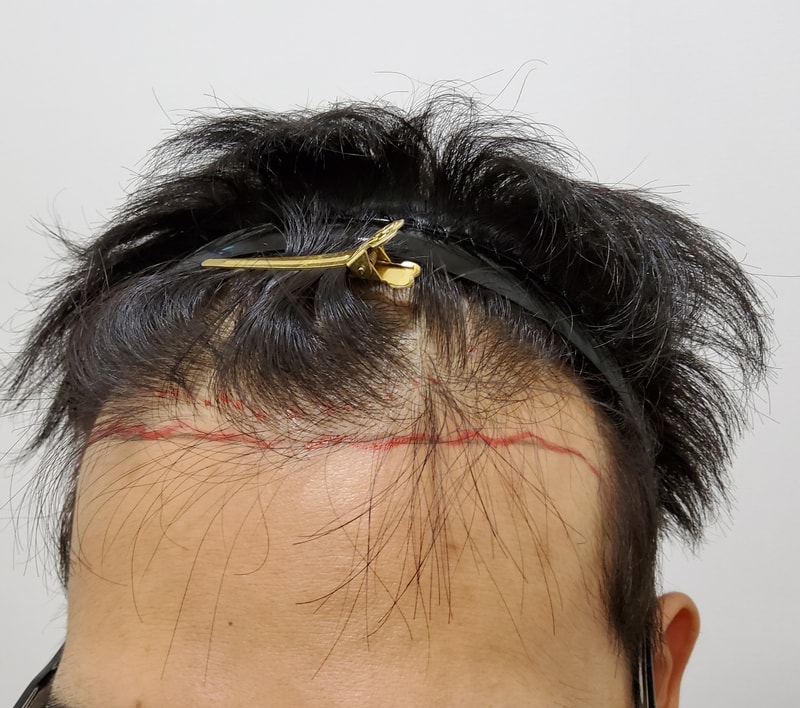 모발이식 나름 빠르게 해봤습니다