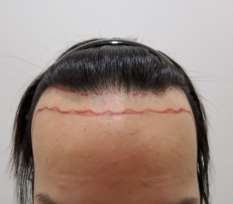 모든모의원 비절개모발이식 1일차네요