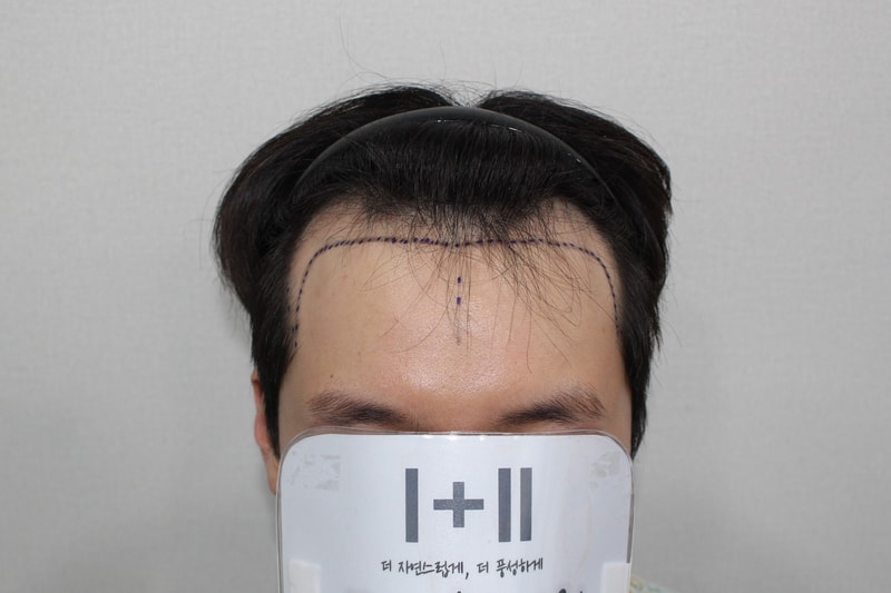 모더함, 남성 비절개 투블럭컷 3864모 수술 1일 차 후기