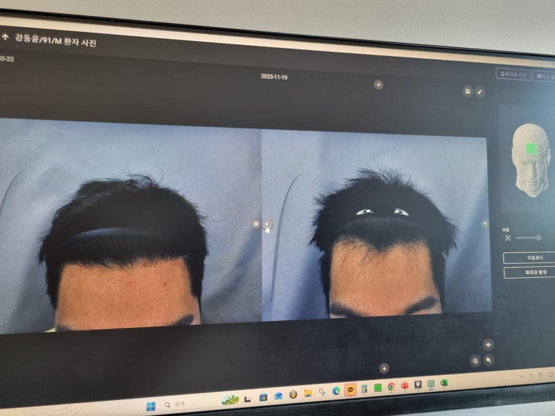 밴스모자이너 m자 비절개 2300모 6개월 후기