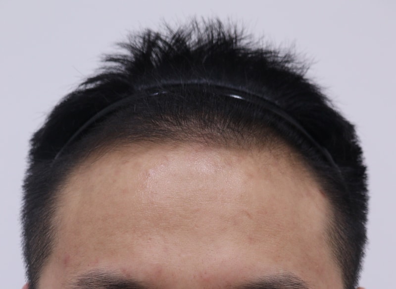 1. 수술전_1.JPG