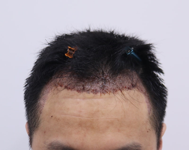 2. 수술후_1일_1.JPG