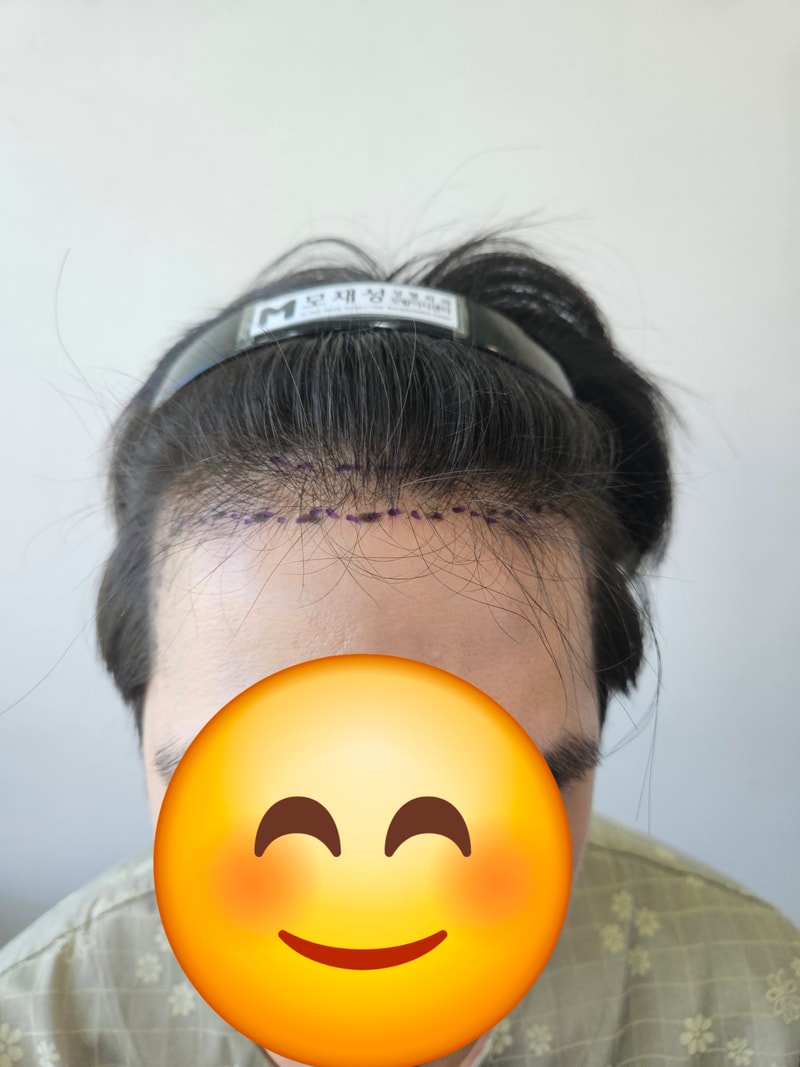 모재성 모발이식센터 1000모낭 비절개(M자) 수술 후기