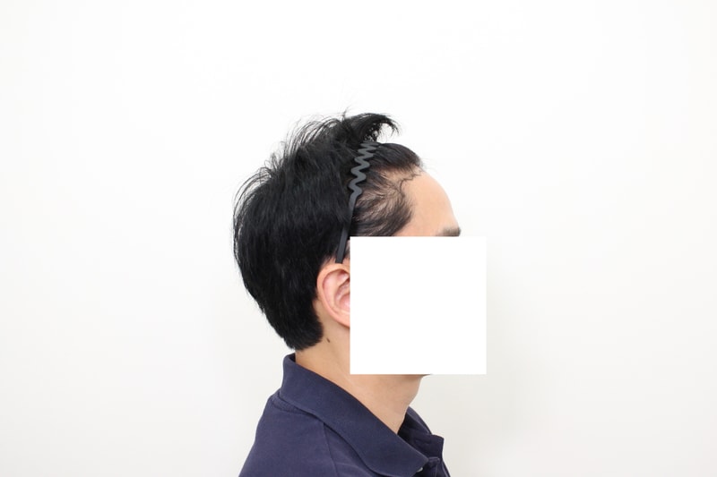 모프로의원(문건학원장님) 모발이식 7개월차 후기 입니다.
