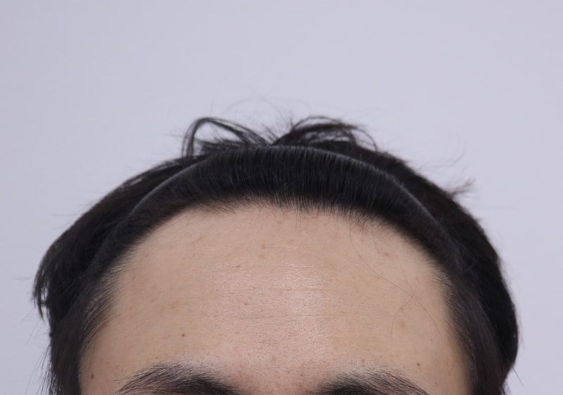 1. 수술전_1.JPG