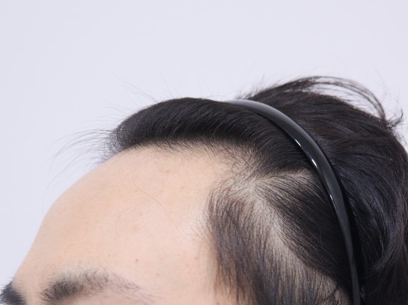 1. 수술전_2.JPG