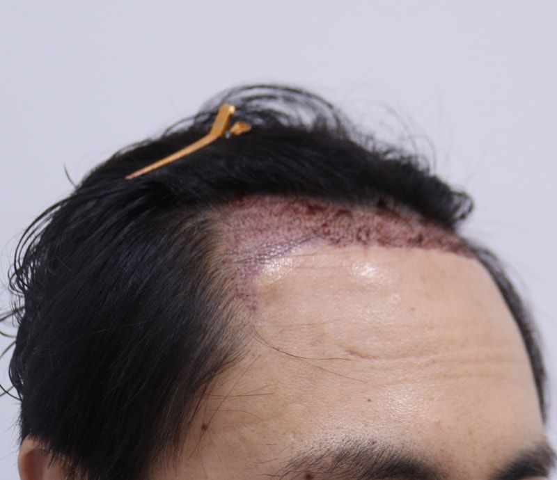 2. 수술후_1일_3.JPG