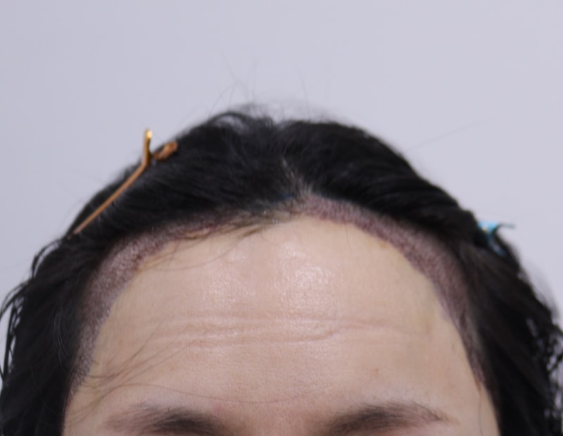 2. 수술후_1일_1.JPG