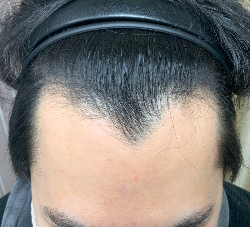남학준95 3500모 이식전 패드.png