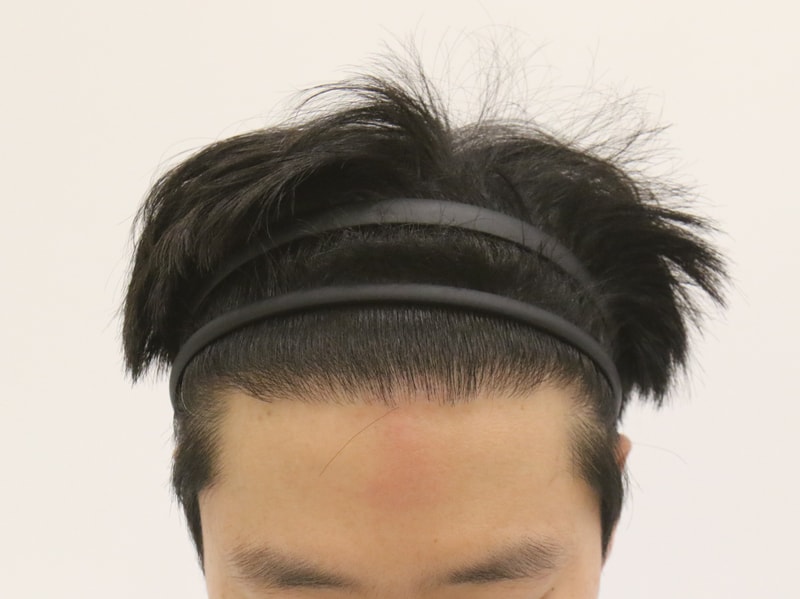 Busan Hair Transplantation Slit-type Mammoth Hair Restoration Center Reoperation M after 8 months