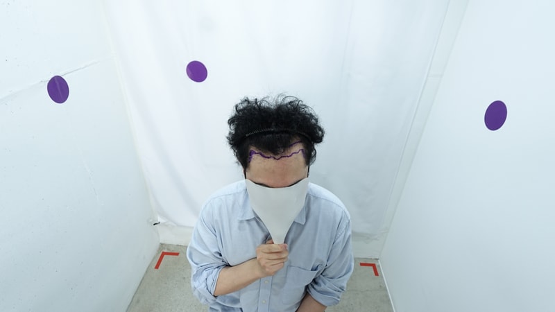 자라다의원 m자 모발이식 후기