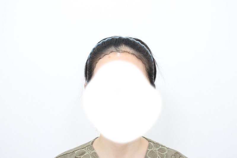 신사동 모프로의원, 헤어라인 이식, 6개월차 후기 