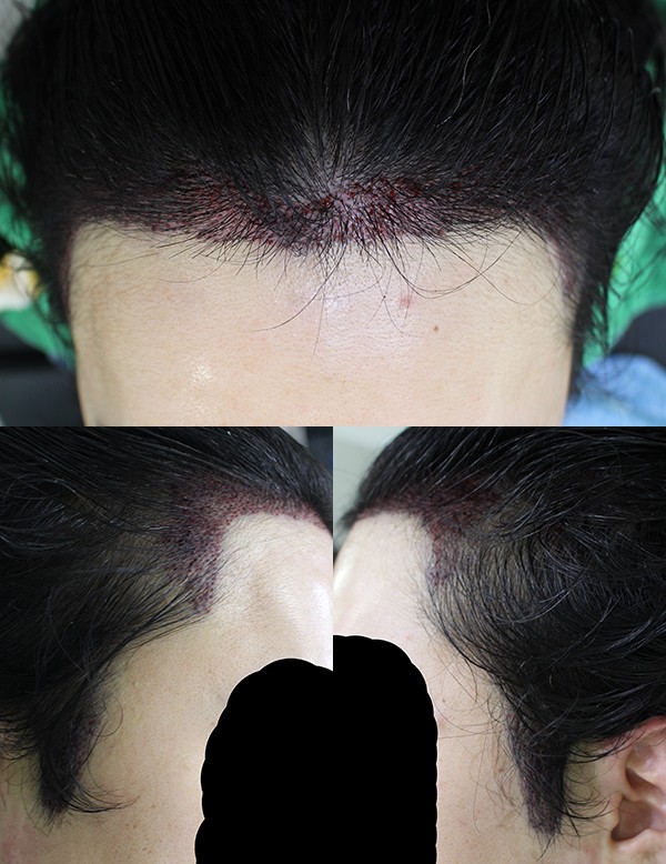 앞머리, 구레나룻 이식 7개월 중간 평가