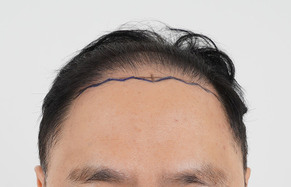 I received a 4,000-mo frontal Hair Transplant for incision at Pangyo Talmo Hospital.