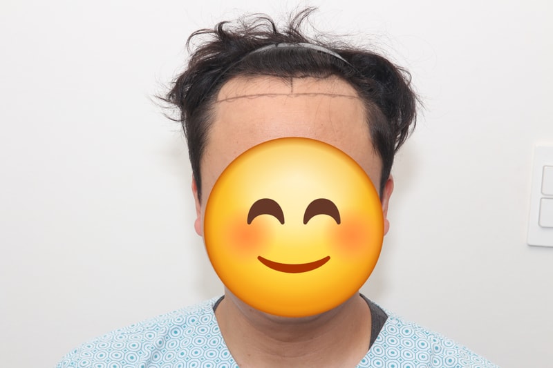 뉴헤어 모발이식 비절개 1607모낭 이식 후 11개월 차