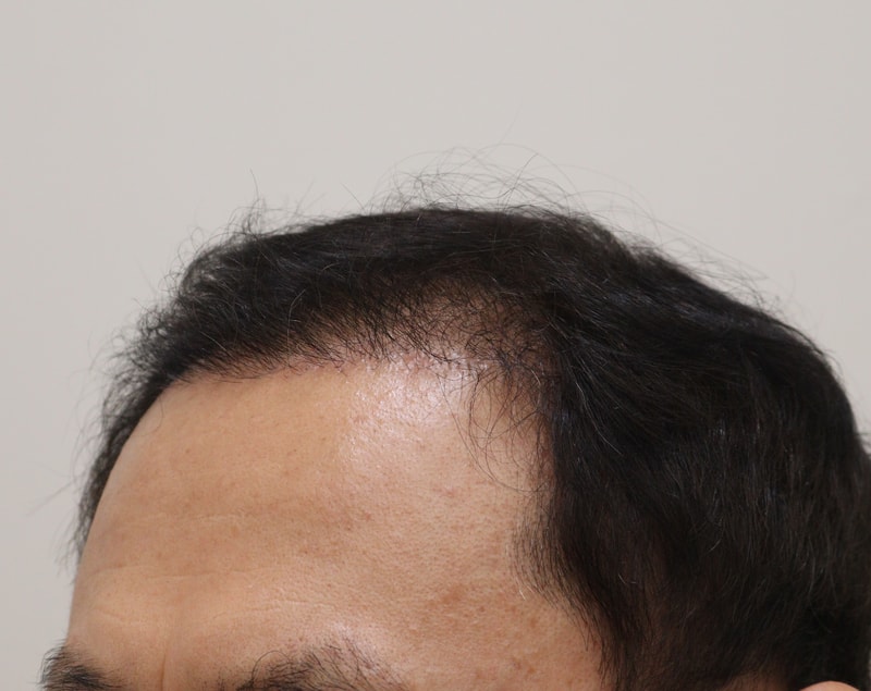 3. 수술후_6개월_2.JPG