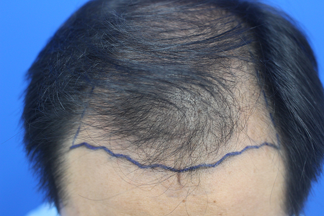 5000모 대량이식 혼용법으로 한나이브에서 받았습니다.