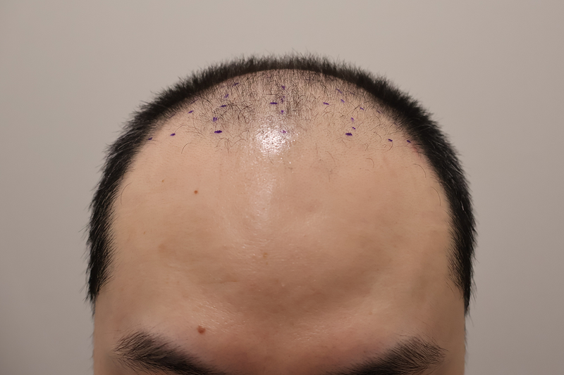 인천 마이모 비절개 모발이식 2600모 1년경과