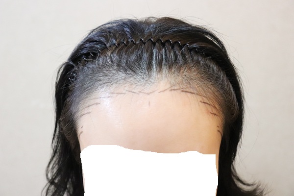 제이피성형외과 헤어라인 혼합 3200모 후기!!