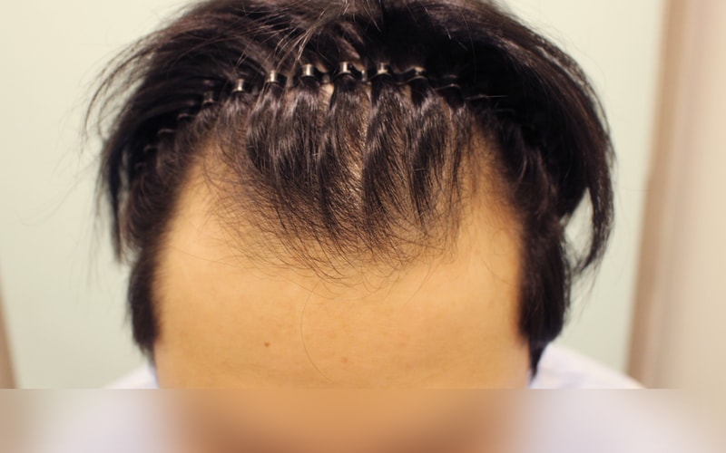 깊었던 엠자탈모 해결방법은 모발이식이네요^^