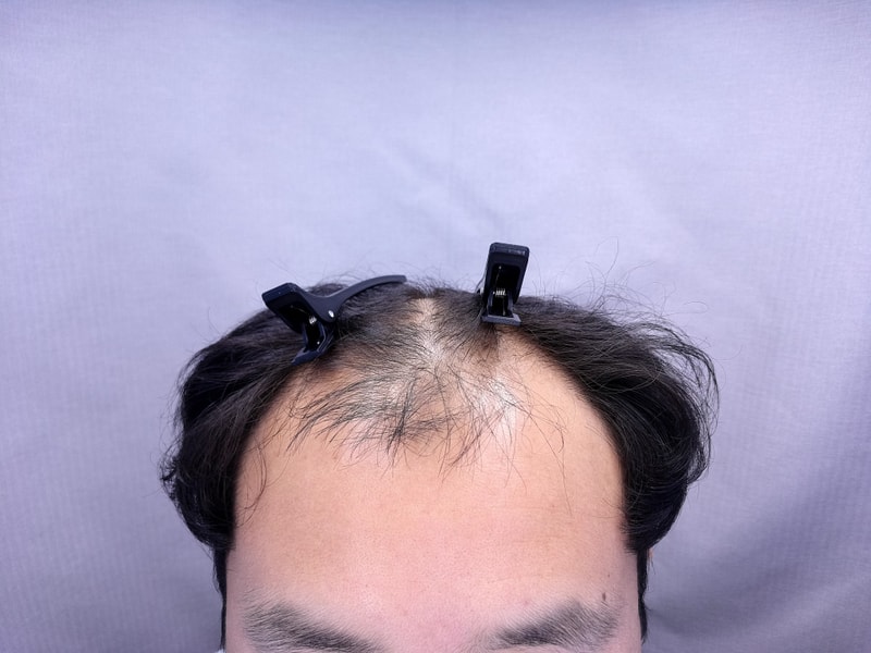 인천연세모벨르 비절개 이식 9개월 후기