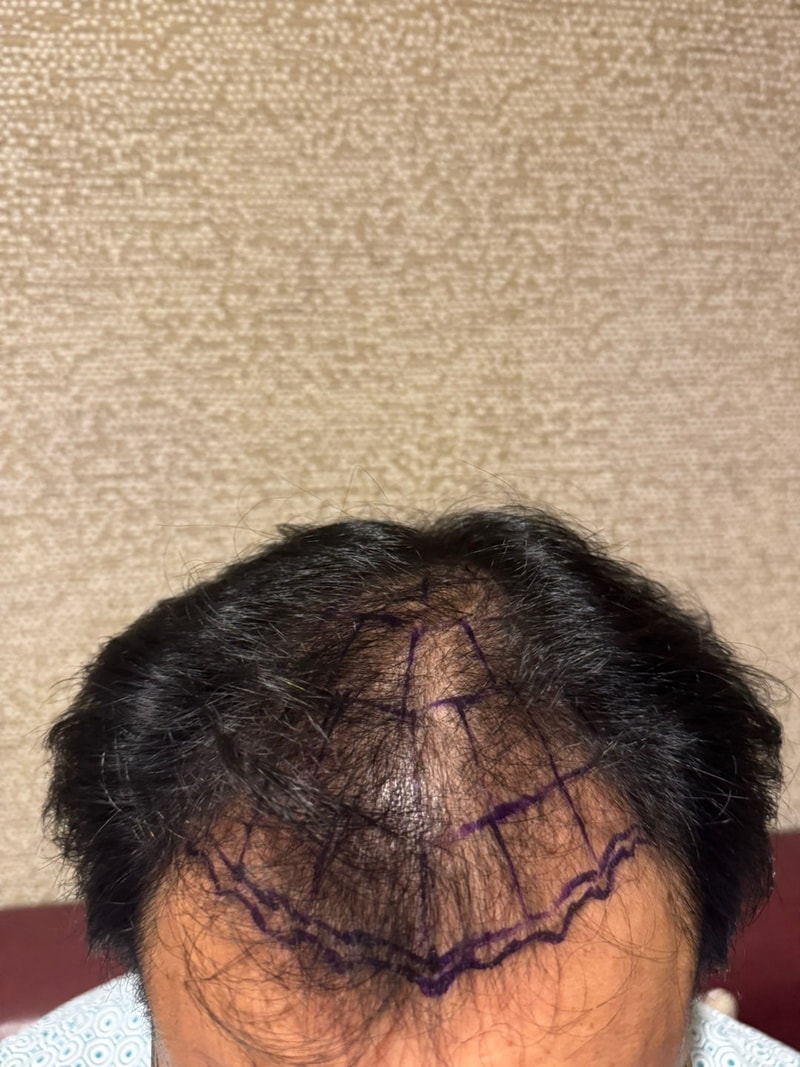 뉴헤어 비절개 모발이식 2000모낭 10개월차 후기입니다~~