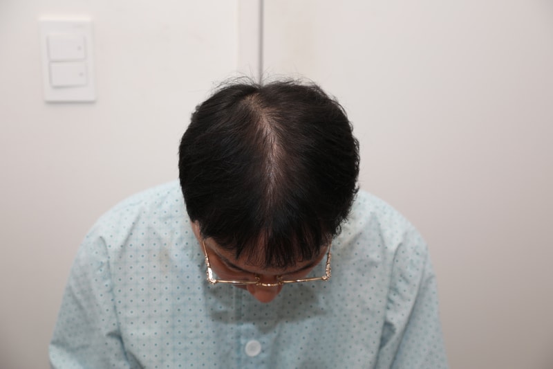 뉴헤어 정수리모발이식 비절개 2차 3,600모  1년 경과
