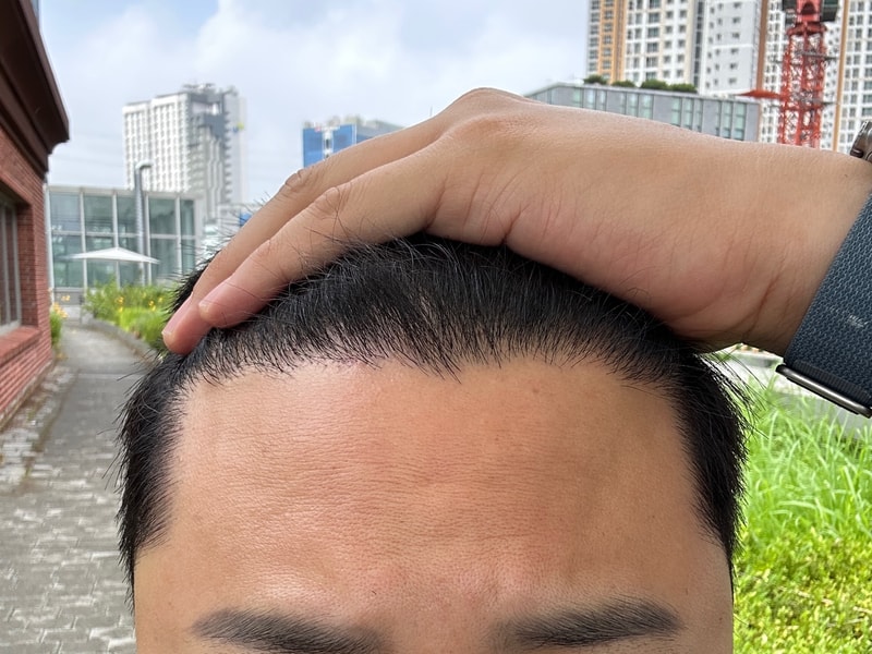 모발이식 180일차 후기 (비절개/1600모낭/강남모발이식병원)