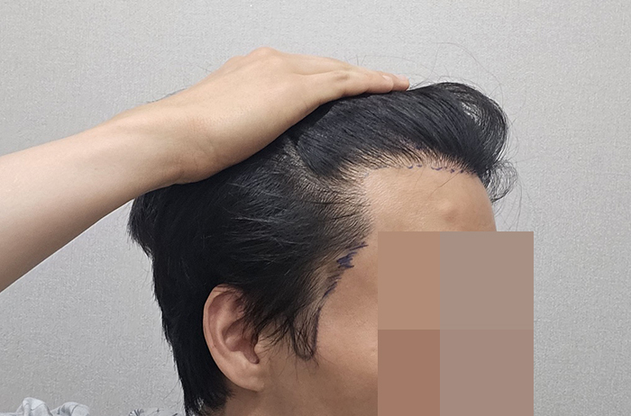 2. 수술전 디인 후.jpg