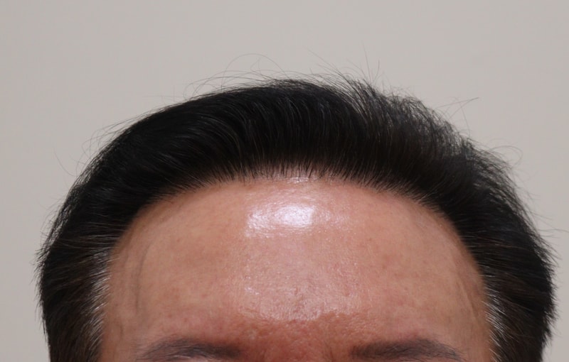 3. 수술후_6개월_1.JPG