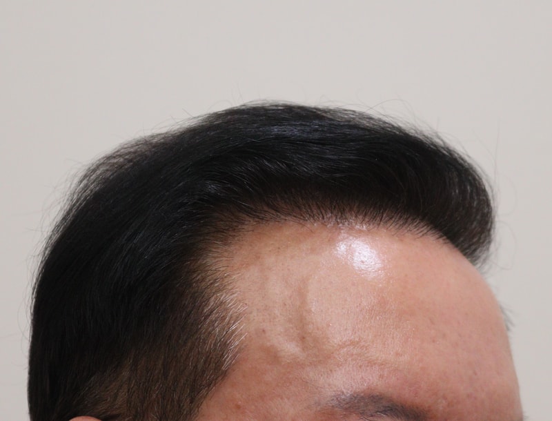 3. 수술후_6개월_4.JPG