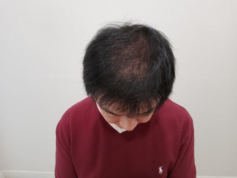 4. 수술후_6개월_2.jpg