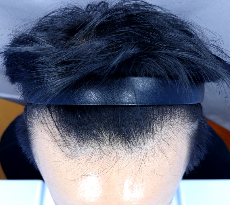 김영남81 이식전.png