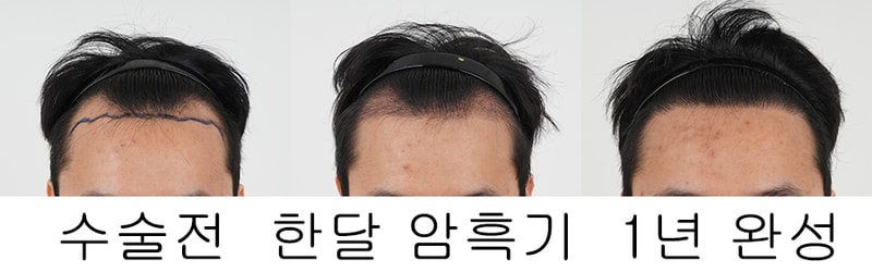 Shinsa Hair Transplantation MOMO HAIR TRANSPLANT Non-Cutting 3,000 Mo Transplantation 1 Year of Birth Hair Transplantation