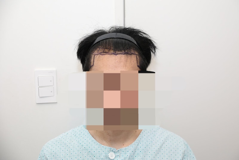 뉴헤어 모발이식 1800모낭 1년3개월후기