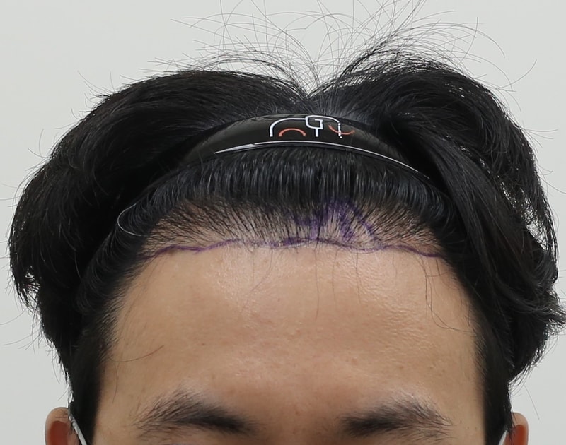 압구정맘모스 비절개 모발이식 7개월 경과체크