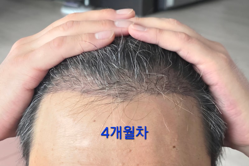 모엠의원 전지훈 원장님 / M자 모발이식 120일차 후기