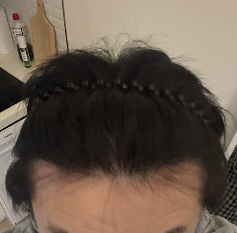 다나 1000모낭 21개월 무삭발후기입니다!