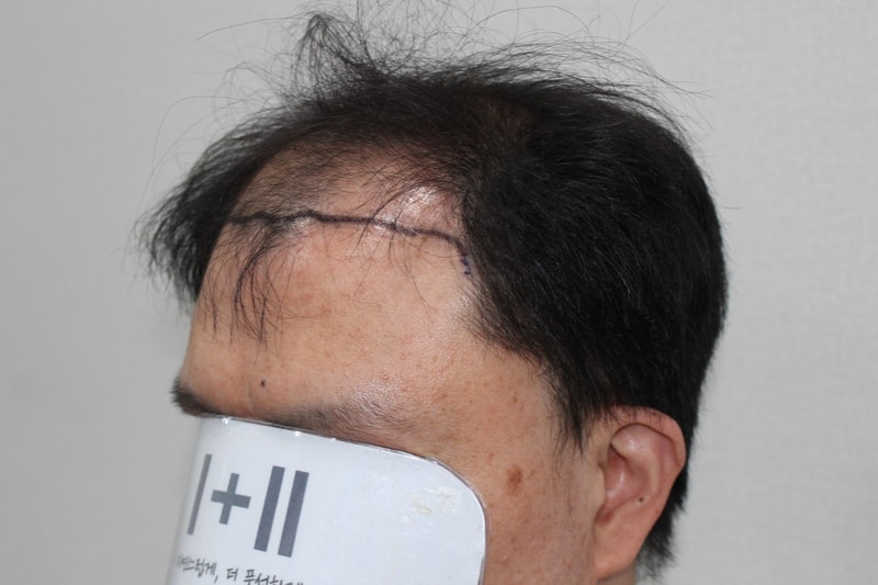 전두부 비절개 수술 , 모더함 정한별 원장님