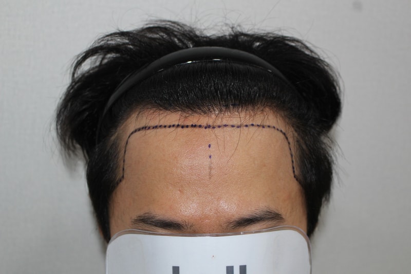 On the first day of the Hair Transplant surgery of Director Shinhan Jong.