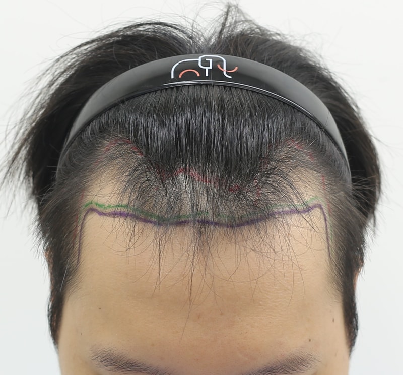 석지웅 원장님 모발이식수술 1일차입니다.