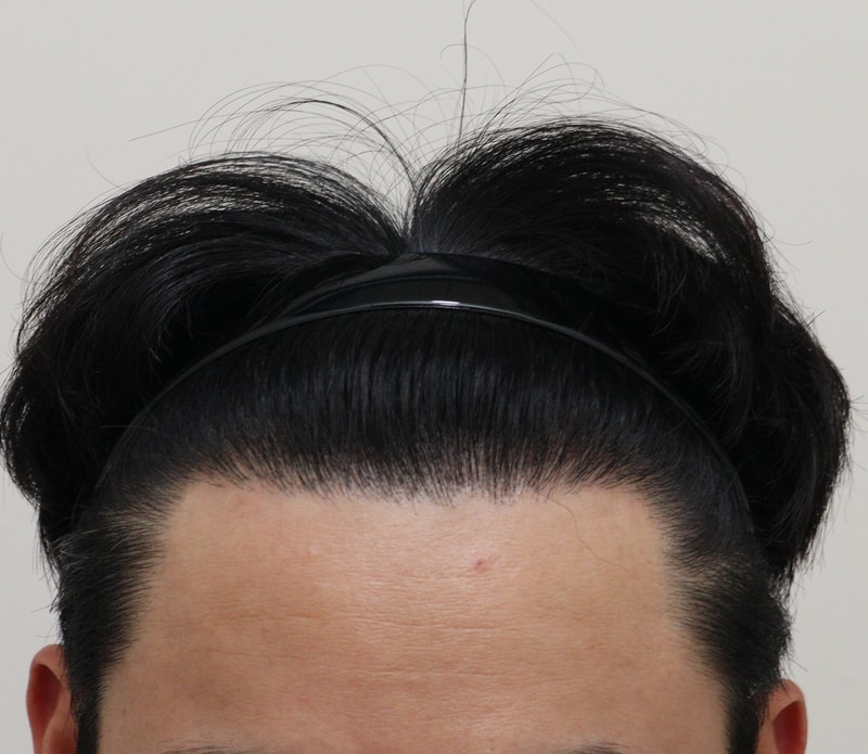 4. 수술후_1년_1.JPG