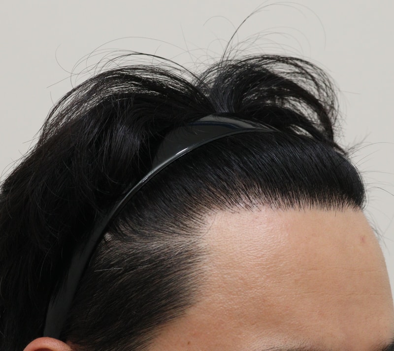 4. 수술후_1년_3.JPG