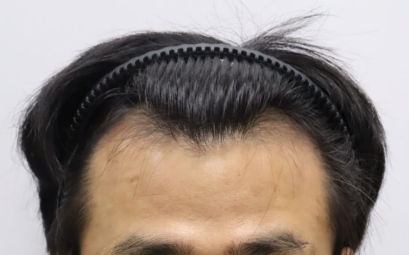40대 M자탈모 포헤어 서울점 권오성 원장님 비절개슬릿 모발이식 4개월 후기 