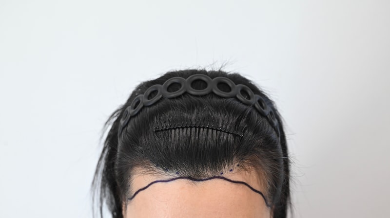 (모엠) 여자 엠자 모발이식 1년 반 후기 